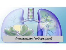 Фтизиатрия (туберкулез)
