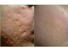 6361163.Dermaroller before after photo 4 acne scar treatment botonics.jpg