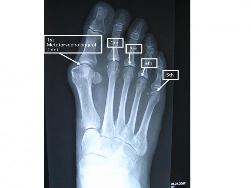 MTP-joints2-500x375.jpg