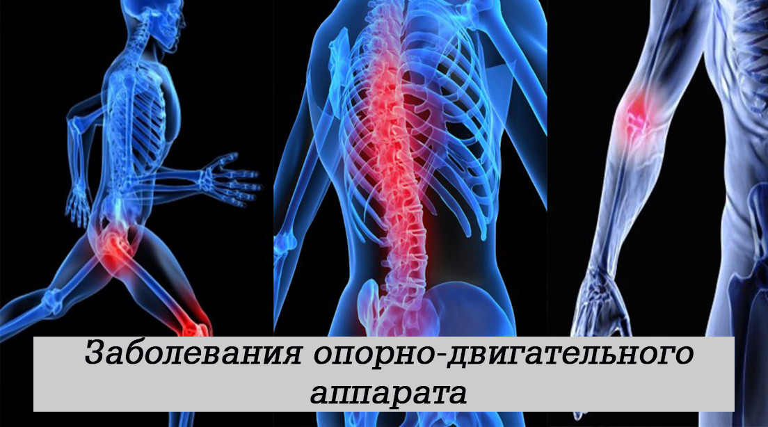 Заболевания опорно-двигательного аппарата