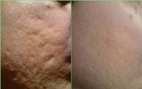 6361163.Dermaroller before after photo 4 acne scar treatment botonics.jpg